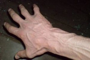 metode liječenja proširenih vena na rukama