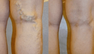 znakovi i simptomi proširenih vena na nogama kod muškaraca