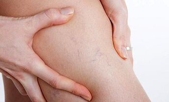 razlozi za razvoj proširenih vena na nogama