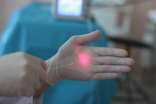 kako se pripremiti za lasersko liječenje proširenih vena