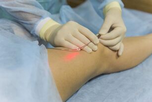 lasersko liječenje proširenih vena suština postupka