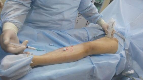 operacija kod varikoznih vena na nogama