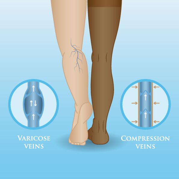 Učinci kompresijskog odjevnog predmeta na proširene vene na nogama