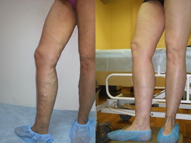 Noge prije i poslije laserskog liječenja proširenih vena