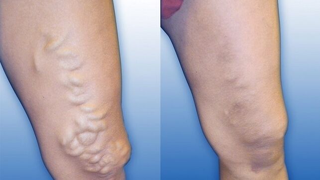 Noge prije i poslije liječenja teških proširenih vena