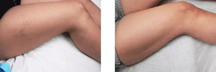rezultat prije i poslije primjene jabučnog octa