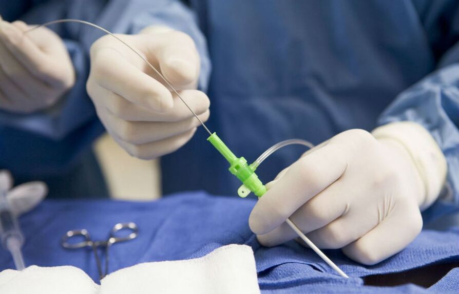 kirurško liječenje proširenih vena