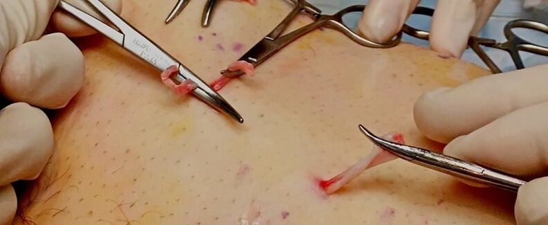 kirurško liječenje proširenih vena na nogama kod muškaraca