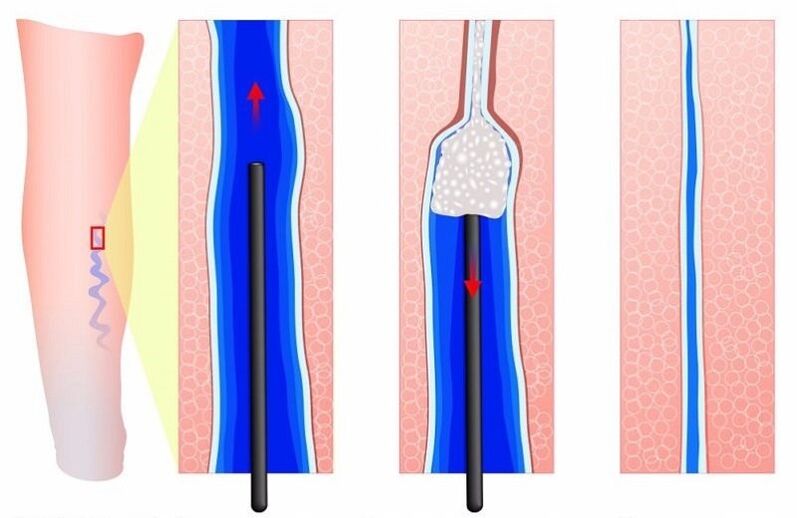 skleroterapija proširenih vena na nogama kod muškaraca